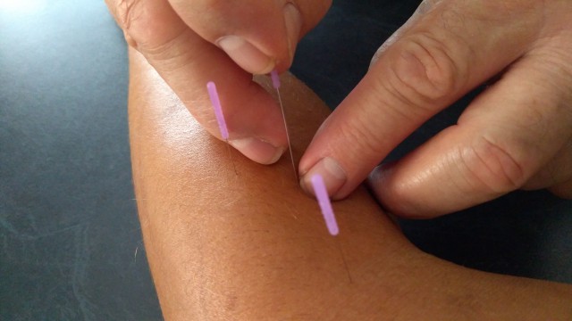 Arm Acupuncture (2019) Arm Acupuncture (2019)